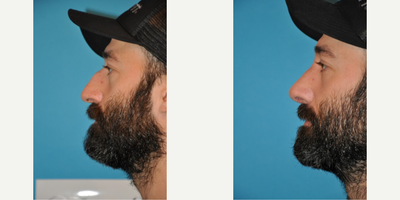 Case 4226 - Man treated with Rhinoplasty