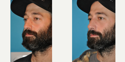 Case 4227 - Man treated with Rhinoplasty