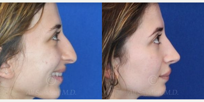 Case 4228 - Woman treated with Rhinoplasty