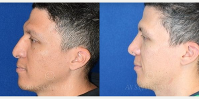 Case 4229 - Woman treated with Rhinoplasty