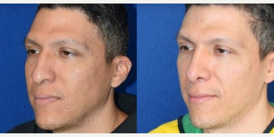 Case 4230 - Woman treated with Rhinoplasty