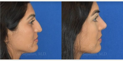 Case 4231 - Woman treated with Rhinoplasty