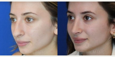 Case 4232 - Woman treated with Rhinoplasty