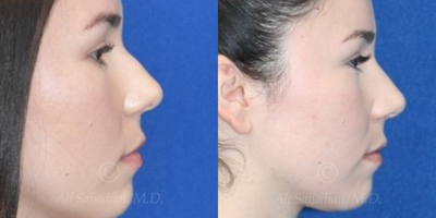 Case 4233 - Woman treated with Rhinoplasty