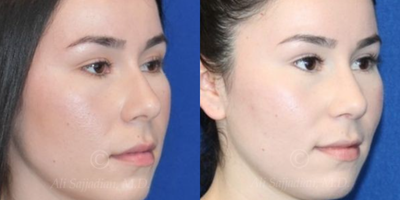 Case 4234 - Woman treated with Rhinoplasty
