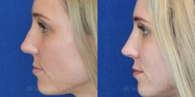 Case 4235 - Woman treated with Rhinoplasty