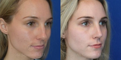 Case 4236 - Woman treated with Rhinoplasty