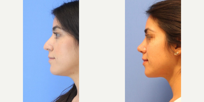 Case 4237 - Woman treated with Rhinoplasty