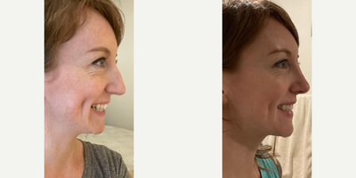 Case 4238 - Woman treated with Rhinoplasty