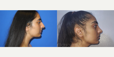 Case 4239 - Woman treated with Rhinoplasty