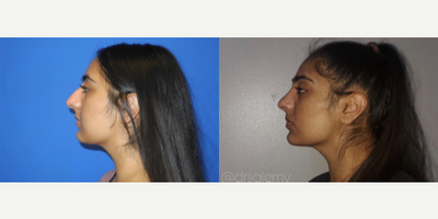 Case 4240 - Woman treated with Rhinoplasty