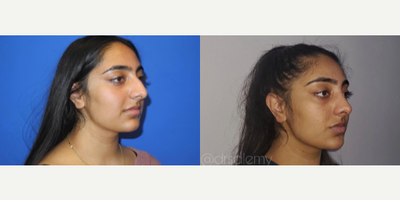 Case 4241 - Woman treated with Rhinoplasty