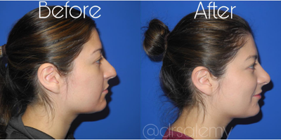 Case 4242 - Woman treated with Rhinoplasty