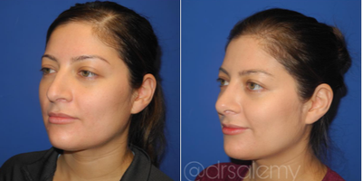 Case 4243 - Woman treated with Rhinoplasty