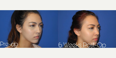 Case 4244 - Woman treated with Rhinoplasty