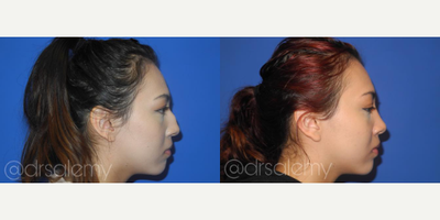 Case 4245 - Woman treated with Rhinoplasty