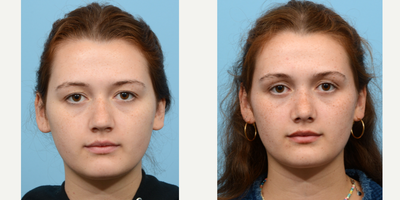 Case 4251 - 18-24 year old woman treated with Rhinoplasty