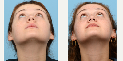 Case 4252 - 18-24 year old woman treated with Rhinoplasty