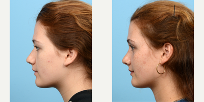 Case 4253 - 18-24 year old woman treated with Rhinoplasty