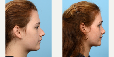 Case 4254 - 18-24 year old woman treated with Rhinoplasty