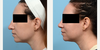 Case 4255 - 35-44 year old woman treated with Rhinoplasty