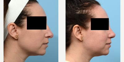 Case 4256 - 35-44 year old woman treated with Rhinoplasty