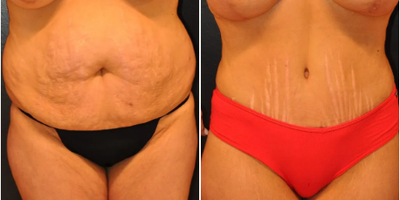 Case 43 - Woman treated with Tummy Tuck