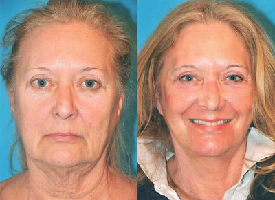 Case 4306 - Woman treated with Rhinoplasty