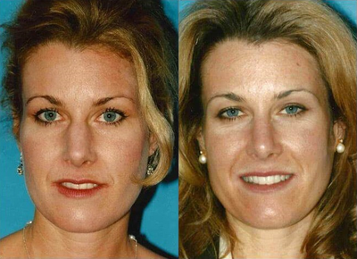 Case 4307 - Woman treated with Rhinoplasty