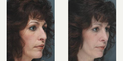 Case 4309 - Woman treated with Rhinoplasty