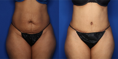 Case 431 - 35-44 year old woman treated with Tummy Tuck