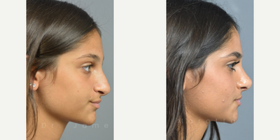 Case 4310 - Woman treated with Rhinoplasty