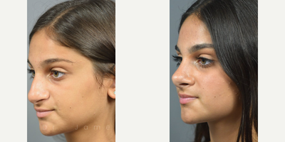 Case 4311 - Woman treated with Rhinoplasty