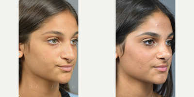 Case 4312 - Woman treated with Rhinoplasty