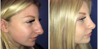 Case 4314 - Woman treated with Rhinoplasty