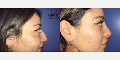 Case 4315 - Woman treated with Rhinoplasty