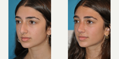 Case 4318 - Woman treated with Rhinoplasty
