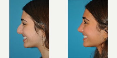 Case 4319 - Woman treated with Rhinoplasty