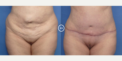 Case 432 - Woman treated with Tummy Tuck