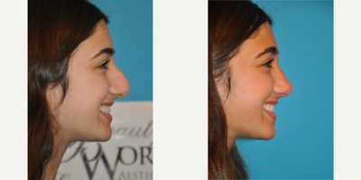 Case 4320 - Woman treated with Rhinoplasty