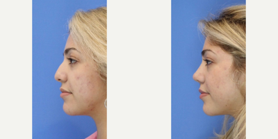 Case 4321 - Woman treated with Rhinoplasty