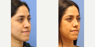 Case 4322 - Woman treated with Rhinoplasty