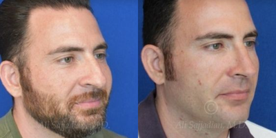 Case 4324 - Man treated with Rhinoplasty