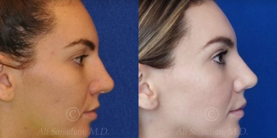 Case 4325 - Woman treated with Rhinoplasty