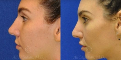 Case 4326 - Woman treated with Rhinoplasty