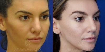 Case 4327 - Woman treated with Rhinoplasty