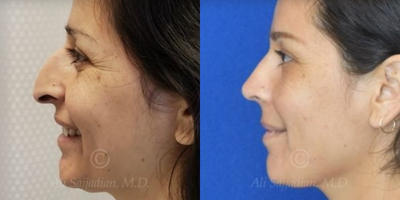 Case 4329 - Woman treated with Rhinoplasty