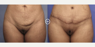 Case 433 - Woman treated with Tummy Tuck