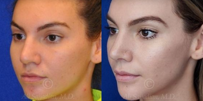 Case 4330 - Woman treated with Rhinoplasty