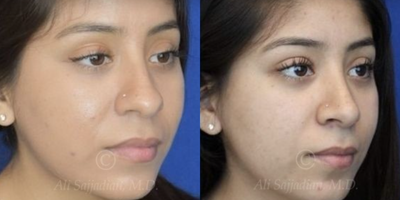 Case 4331 - Woman treated with Rhinoplasty